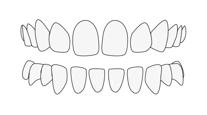 B2B Diastema