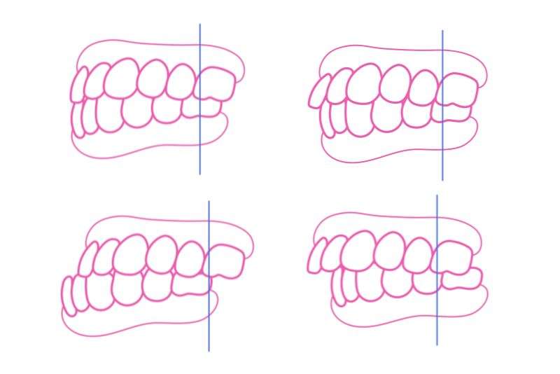 Misaligned teeth cases