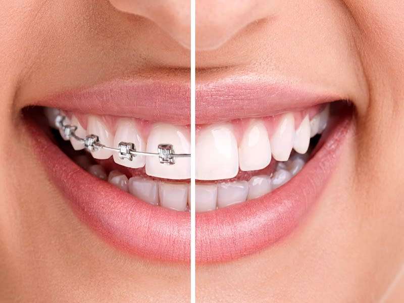 Tandställning: räls eller osynlig tandskenat? 