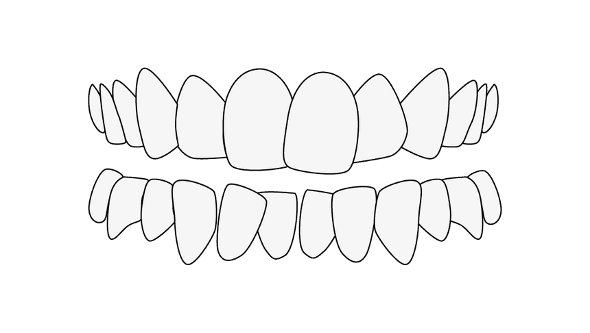 Tandträngsel