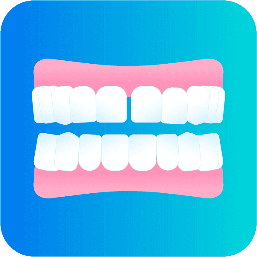 Illustration Diastema