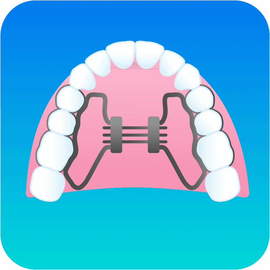 Illustration Palatal Expander